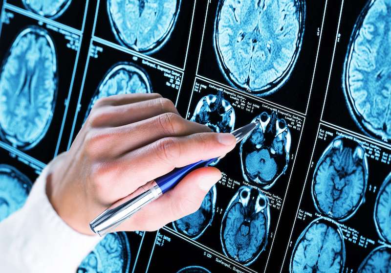 Die Krankheit Epilepsie ist auf eine Störung im Gehirn zurückzuführen.